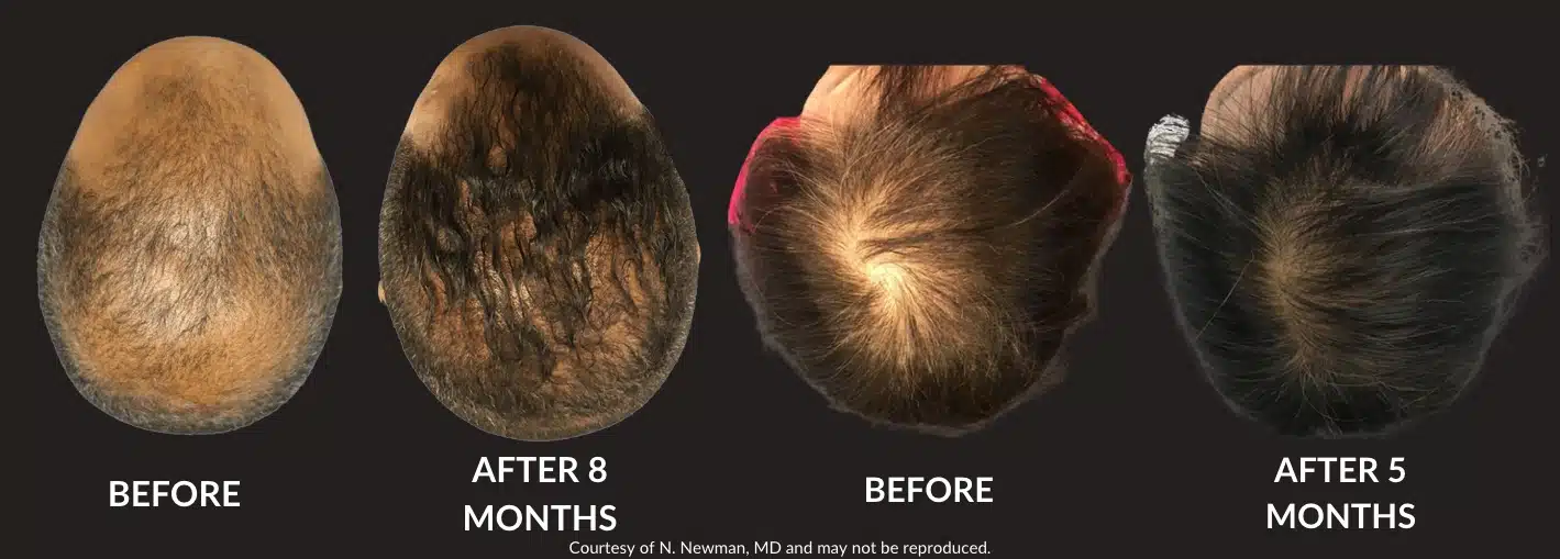 a comparison of hair loss